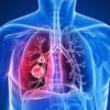 Bronchitis > Symptoms | Treatments | Causes | Diagnosis | Complications | When to see a doctor | Outlook
