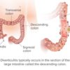 Diverticulitis > Symptoms | Causes | Diet | Risk factors | Diagnosis | Treatment | Complications