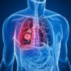 Mesothelioma > What is mesothelioma? | Symptoms | Causes | Diagnosis | Treatment | Outlook