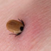 Lyme disease > Symptoms | Transmission | Diagnosis | Treatment | Prevention