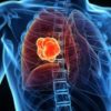Lung cancer > What is lung cancer? | Symptoms | Diagnosis | Staging | Treatment | Outlook | Takeaway